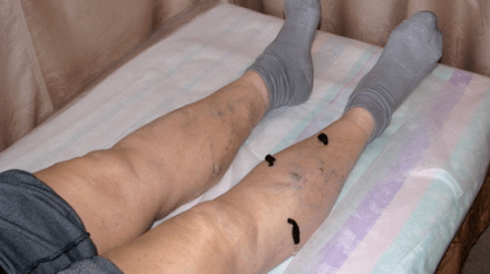 Behandlung von Krampfadern mit Blutegeln