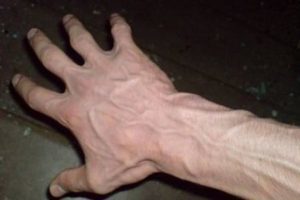 Methoden zur Behandlung von Krampfadern in den Händen