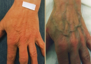 Ursachen von Krampfadern an den Händen