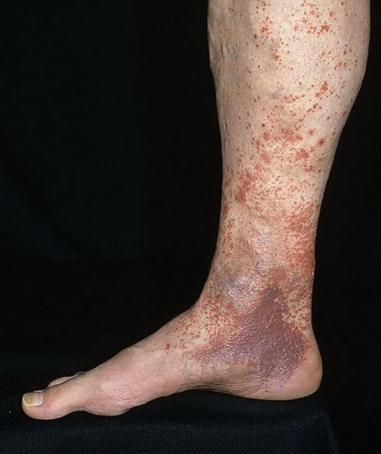 Krampfungsdermatitis