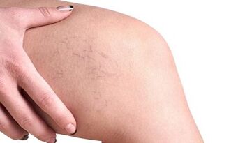 Entwicklungsstadien von Krampfadern