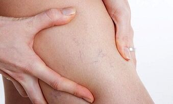 Gründe für die Entstehung von Krampfadern in den Beinen