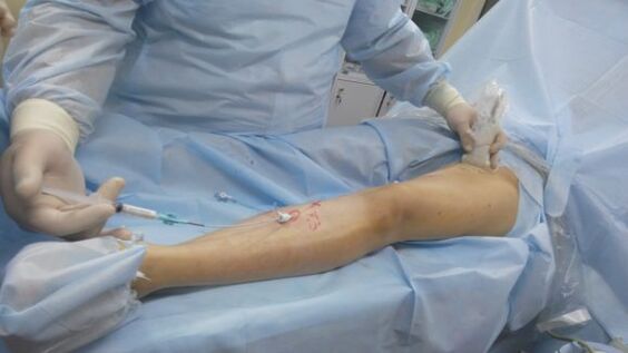 Operation bei Krampfadern in den Beinen