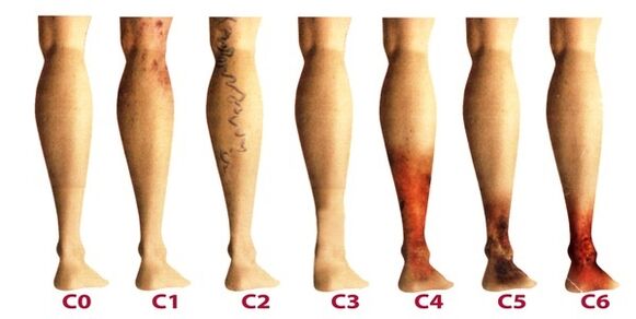 Entwicklungsstadien von Krampfadern an den Beinen